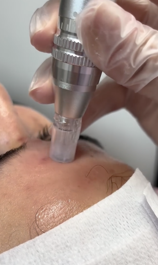 HydraFacial